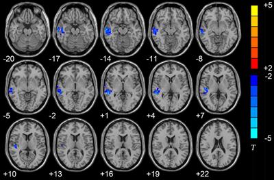 The Abnormal Functional Connectivity between the Hypothalamus and the Temporal Gyrus Underlying Depression in Alzheimer’s Disease Patients